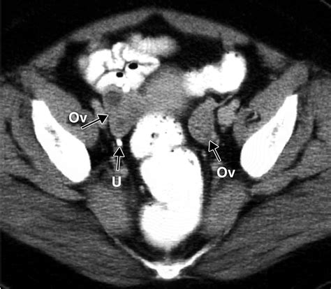 semne CT ovariene varicoase